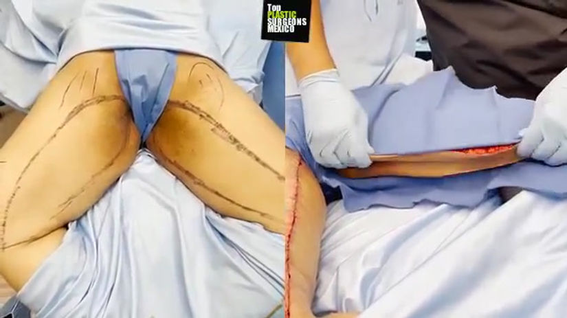 MEDIAL THIGH LIFT (extended incision)